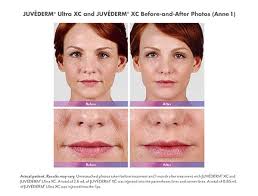 Juvederm Reynolds Plastic Surgery Springfield Mo
