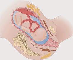 Nu te speria, acest lucru se intampla frecvent. Cordonul Ombilical In Jurul Gatului
