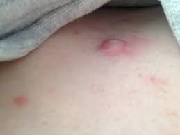 Le lait, responsable de poussées de points noirs et de petits boutons sur la peau ? Gros Bouton Rouge Tres Douloureux Resolu Dermatologie Journal Des Femmes