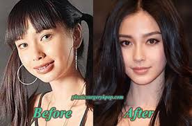 Double eyelid surgery this kind of procedure had been used by many korean stars. Angelababy Plastic Surgery Before And After Pictures Plastic Surgery Photos Celebrity Plastic Surgery Plastic Surgery