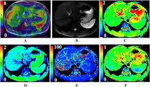 The vaccine should be stored in a refrigerator at a temperature between 2°c and 8°c. A 45 Year Old Male Patient With Chronic Hepatitis B With Fibrosis Stage Download Scientific Diagram