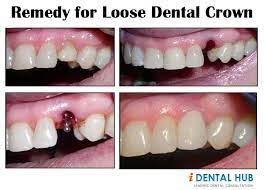 Remedy For Loose Dental Crown Dental Crowns Dental Cosmetic Dentistry Veneers