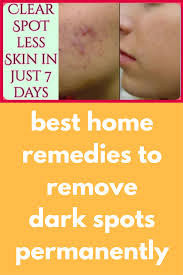 This method is effective in removing dark spots in any part of the body like face, shoulders, buttocks and chest. Best Home Remedies To Remove Dark Spots Permanently Today I Will Share Dark Spots Removing Natural Remove Dark Spots Anti Aging Skin Treatment Skin Treatments