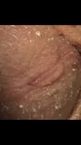 Vous souffrez d'infections urinaires à répétition ? Boutons Douloureux Qui Reviennent Et Repartent Ds La Meme Journee Infections Sexuellement Transmissibles Forum Sante Doctissimo
