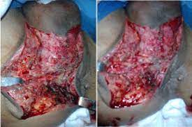 Save a life by knowing the signs and the most effective interventions. Fournier S Gangrene Descriptive Analysis And Outcome Of Eleven Cases