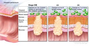 Table Table 4 Definitions Of Tnm Stages Iiia Iiib And Iiica Pdq Cancer Information Summaries Ncbi Bookshelf