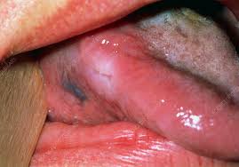 Image result for white cancer on tongue)