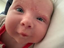 Image result for Cradle Cap