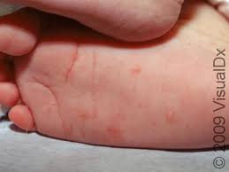 Image result for scabies human bites