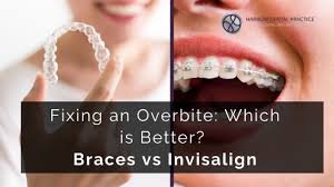 It can take anywhere from 6 months to 1 year depending upon the type of overbite braces and severity duration may vary. Fixing An Overbite Which Is Better Braces Vs Invisalign Harrow Dental Practice Blog