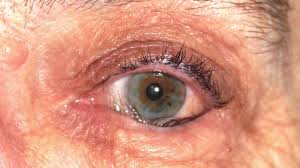 Treatments last upto 4 years! Entropion Eye Physicians Surgeons Billings Mt