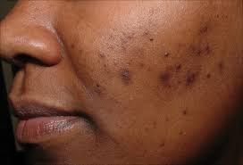 Image result for Postinflammatory Hyperpigmentation