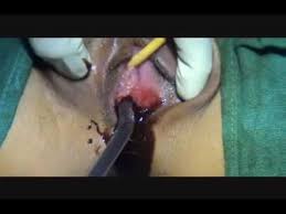 Hymenectomy For Imperforate Hymen Youtube