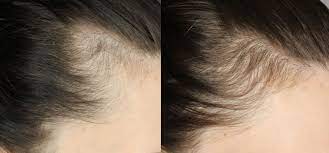 The scientific term for this condition is known as postpartum alopecia. Updated How I Am Growing My Hair Back Post Pregnancy Justina S Gems
