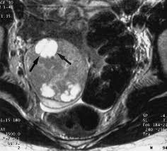 Ct And Mr Imaging Of Ovarian Tumors With Emphasis On Differential Diagnosis Radiographics