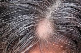 If a person notices significant hair thinning or the development of bald patches, they may be experiencing hair loss. Pictures Thinning Hair Hair Loss In Women
