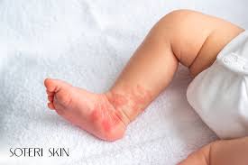 Image result for sweat rash on back baby