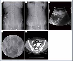 Demonstration Of A Sigmoid Colon Fistula Using Ct With Gastrografin Enema Shi Quantitative Imaging In Medicine And Surgery