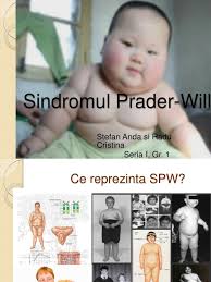 This leads to a number of problems and is thought to affect part of the brain called the hypothalamus, which produces hormones and regulates growth and appetite. Odijelo Povecanje Standard Prada Willi Sindrom Tedxdharavi Com