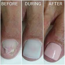 Since 1878, women have been getting their nails done in the us at various salons and parlors. Lcn Barefoot Reconstruction The Traveling Pedicurist