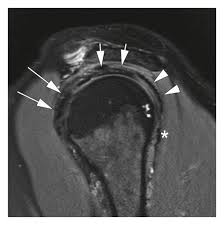 Image result for Shoulder MRI
