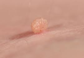 Can your kids get skin cancer? Skin Tag Removal Why You Shouldn T Diy Health Essentials From Cleveland Clinic