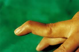 The boutonniere deformity (see the image below) describes agrawal s, misra r, aggarwal a. Rheumatoid Arthritis Amboss