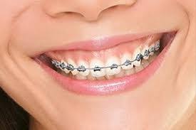 Can Fast Braces Help In Improving The Alignment Of Smiles In Fl 33144 Brackets Dentales Brackets Dental