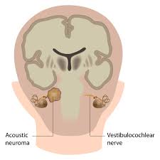 Tinnitus is commonly known as ringing in the ears. but that's a bit of a misnomer. Acoustic Neuroma Harvard Health