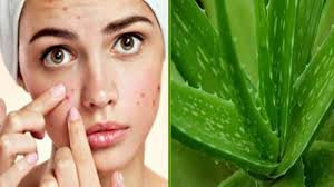 Cara Menghilangkan Jerawat Dengan Lidah Buaya Dalam 7 Hari Dijamin