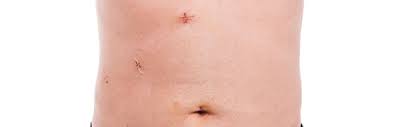It'll usually take around 2 weeks to return to your. What To Expect After Gallbladder Removal Gallbladder Removal Surgery Port Jefferson Ny