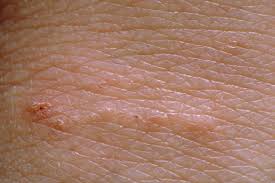 Scabies is a skin condition caused by microscopic mites called sarcoptes scabei. Scabies Nhs