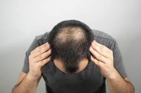 The result is a potent product that helps fight hair loss while stimulating hair growth. The Things To Do For Preventing Hair Loss Film Daily