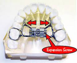 What Is A Rapid Palatal Expander Dental Fun Expanders For Teeth Orthodontics