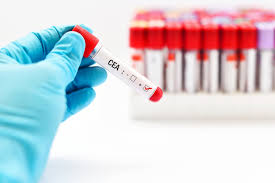 All About Carcinoembryonic Antigen Test Cea Test