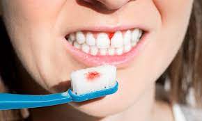 How To Deal With Pyorrhea Symptoms Treatment Cause And Cure Kirkland Premier Dentistry General Dentistry