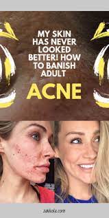 Find More Information On Acne Simply Click Here For More Skincarepimplesovernight Acne Redness Pimples Remedies Oily Skin Treatment
