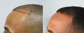 Most people say that the crown area is a black hole so i decided to try smp to fill in and give density. Men S African American Hair Transplant Dr Sean Behnam