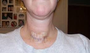 A Picture Of My Neck And Thyroid Scar 5 Days After Thyroid Surgery Half Of The Thyroid Was Re Thyroid Surgery Thyroid Surgery Recovery Thyroid Removal Surgery