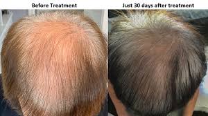 Donor hair options for hair transplant. Alvi Armani Artistic Hair Transplants Beverly Hills Los Angeles Fue Hair Restoration