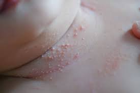 Image result for sweat rash on back baby