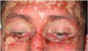 If you have signs and symptoms, call 911 or emergency medical help, or go to an emergency room immediately. Stevens Johnson Syndrome To Allopurinol Download Scientific Diagram