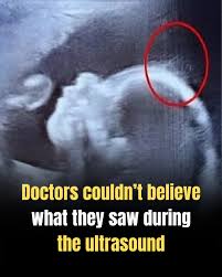 Doctors couldn't believe what they saw during the ultrasound 👀👇