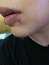 How Do I Treat An Infecinfected Lip Piercing Im Pretty Sure It Is Infected There S Aa Small Bump Filled With Pus Right Next To The Hole Legitpiercing