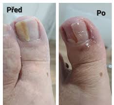 Image result for mykoza nehtů