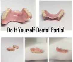 The more you buy, the more you save using a professional grade material that a dentist would use to reline your denture at a fraction of the cost. Do It Yourself Denture Kit Make Your Own Temporary Etsy Affordable Dentures False Teeth Dental Impressions