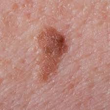 Image result for liver spots on legs