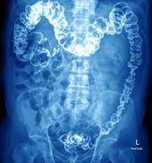 Before After 3 Ways Your Gi Icd 10 Coding Will Change Oct 1