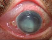 Image result for Acute Red Eye