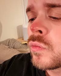 nose tip has been throbbing all week, treat at home or get appt? Looking  like Rudolph just in time for Christmas 🫡 This was hurting more a couple  days ago but it's